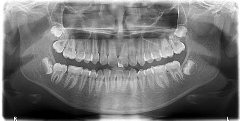 What is an OPG - Orthopantomogram | Bond Radiology