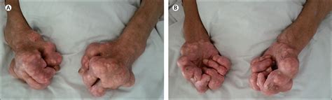 Giant gouty tophi in the hands - The Lancet Diabetes & Endocrinology