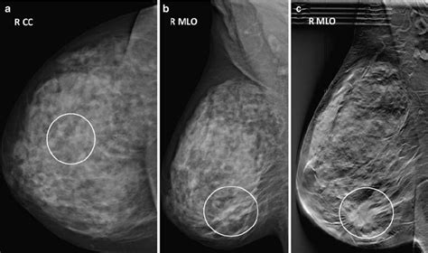 Patient with a 2.8-cm, grade 3, invasive ductal carcinoma in the right... | Download Scientific ...