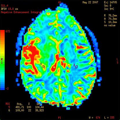 Perfusion Mri Imaging Of A Malignant Brain Tumor Stock Photo - Download ...