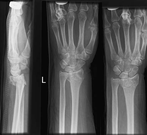 Colles’ Fracture - Pictures, Treatment, Healing Time, Surgery, Symptoms ...