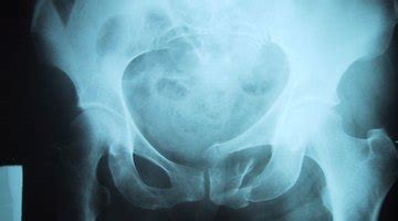 Types of Pelvic Calcifications | Healthfully