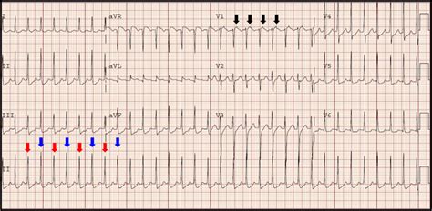 Figure 1. ECG showing AVNRT at the time of presentation. Note electrical alterans indicated by ...