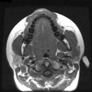 Malignant Parotid Tumor Imaging: Overview, Radiography, Computed Tomography