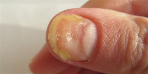 Nail Disorders - San Luis Obispo, CA | Coastal Dermatology + Aesthetics