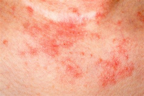 Eczema Facts: Things You Need To Know | Reader's Digest