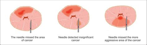 Prostate Biopsy | 3T MRI Prostate Cancer Imaging & Detection | Dr Richard Goldberg | CPT 72197 ...