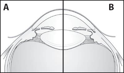 Angle-Closure Glaucoma: Evaluation and Treatment After Iridotomy | Ento Key