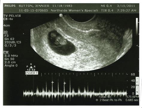 8 Week Ultrasound: The Moment Of Truth | Robb Sutton