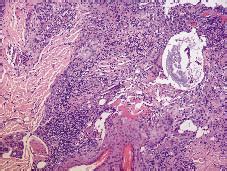 Cetuximab-induced Acneiform Eruption and the Response to Isotretinoin | HTML | Acta Dermato ...