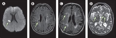 Mechanisms of sporadic cerebral small vessel disease: insights from neuroimaging - The Lancet ...