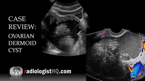 Dermoid Cyst || Ultrasound || Case 164, 57% OFF