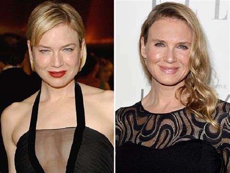 Renee Zellweger Before and After Plastic Surgery: facelift, botox