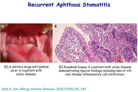 Oral Mucosal Disease Recurrent Aphthous Stomatitis