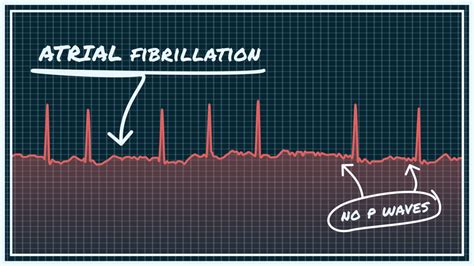 What Atrial Fibrillation (Afib) Looks Like on Your Watch ECG | Qaly