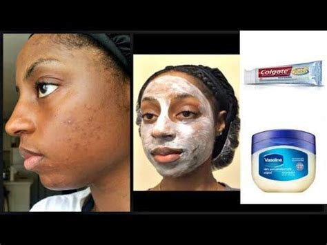 Before And After Using Vaseline For Acne | Before And After