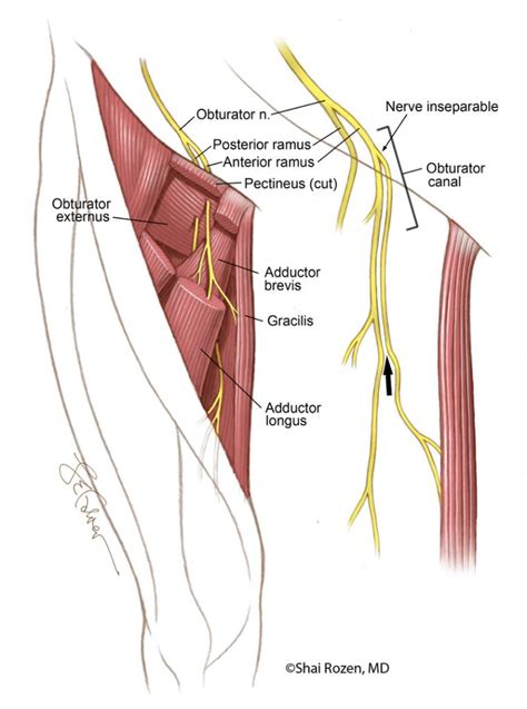 Free Functional Muscle Flap | Shai M. Rozen, M.D., F.A.C.S.