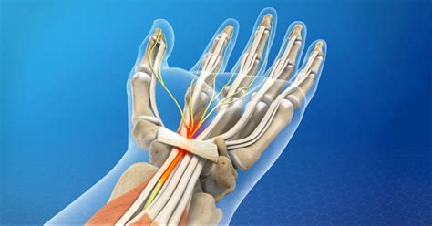 Understanding Carpal Tunnel Syndrome - Brandon P. Donnelly, MD