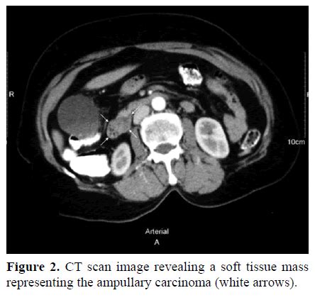 Ampullary Carcinoma Associated with an Annular Pancreas