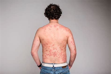 Psoriasis Rash On Back