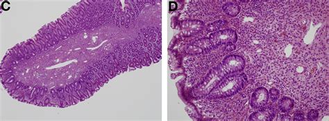 Incidentally Found Unusual Polyp on Cecum - Gastroenterology