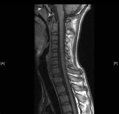 Neurosurgery: Traumatic C2 dens fracture (Type II)