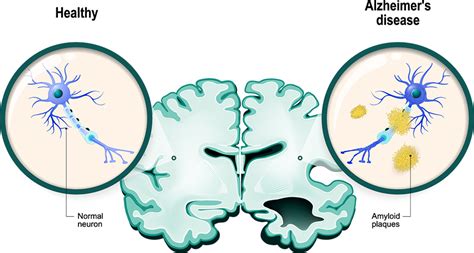 Disruption of amyloid β-protein processing drives Alzheimer’s