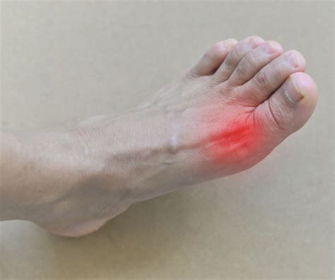 What Causes Gout In The Foot? – My FootDr