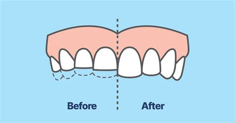 How to Fix Teeth Grinding - On Point Dental