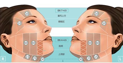 HIFU Adverse Reactions – Areton Limited