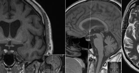 Radiology MRI: Anterior Commissure