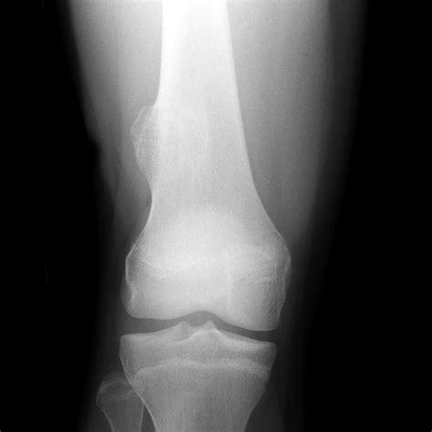 Osteochondroma | Image | Radiopaedia.org