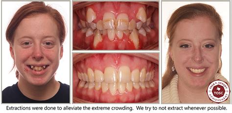 Before and After - Scott Orthodontics | Webster TX