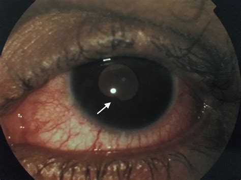 Cureus | A Rare Case of Neurosyphilis with Ocular Involvement in a Patient with HIV Infection ...