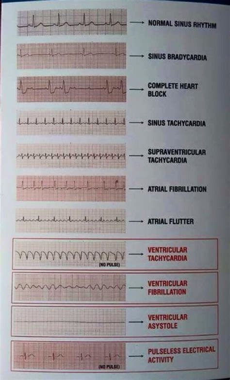 Cheat Sheet Ekg Strips Examples Basic Ekg Ecg Rhythms Cheatsheet | Images and Photos finder