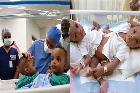 Conjoined Nigerian twins separated in Saudi Arabia | The Nation Newspaper