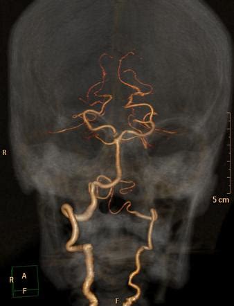 Vertebral Artery