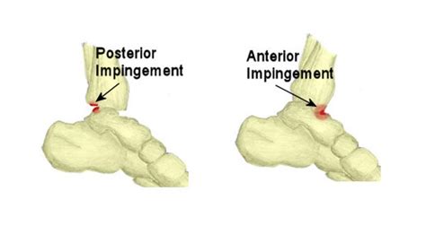 Ankle Impingement Syndrome Causes Symptoms Diagnosis Amp Treatment - Bank2home.com