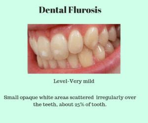 Dental Fluorosis - Symptoms, Causes, Treatments