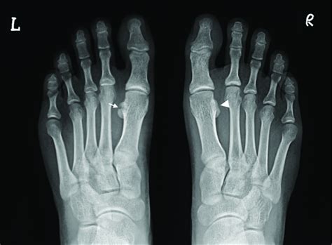 Imaging Findings of Bilateral Medial Hallucal Sesamoid Insufficiency in a Marathon Runner ...