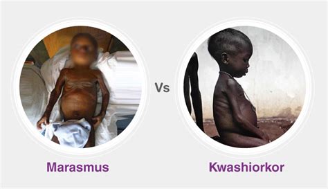 Describe A Child Suffering From Kwashiorkor - Askworksheet