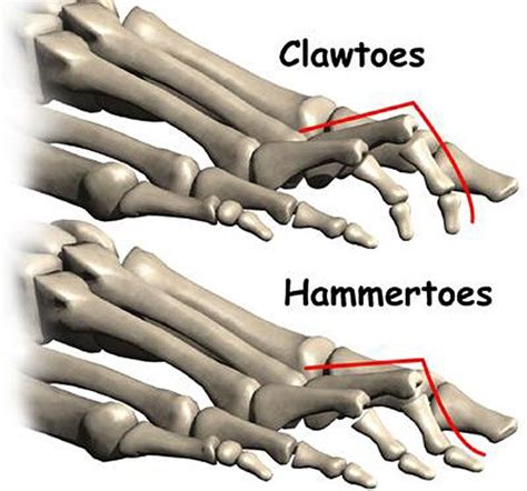 Les 48 meilleures images du tableau Charcot Marie Tooth sur Pinterest | Amazing, Augmentation et ...