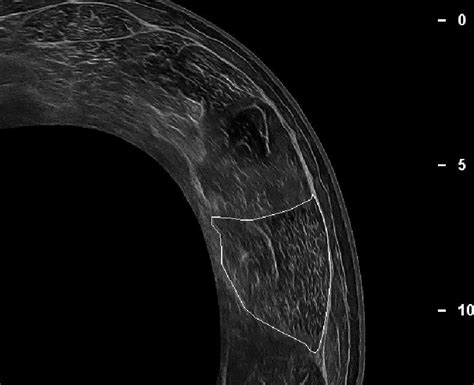 Cross-sectional image at 60% muscle length (=100% proximal myotendinous... | Download Scientific ...