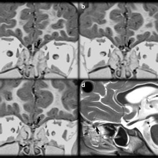 Brain MRI in an 8-year-old TSC girl with bilateral olfactory bulb... | Download Scientific Diagram