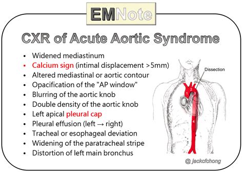 Aortic Dissection Symptoms