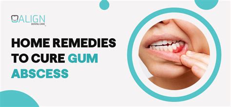 7 effective home remedies for Gum Recession - Dr. Nasar Abdul