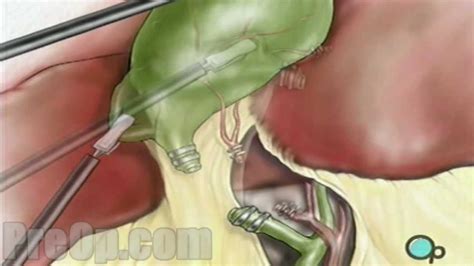 Gallbladder Removal Laparoscopic Surgery Patient Education - YouTube