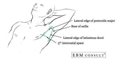 Chest Tube Thoracostomy triangle if safety | Chest tube, Medical ...