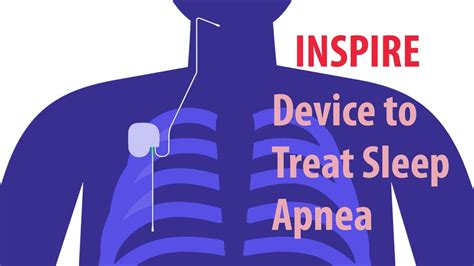 Inspire Device for Sleep Apnea: Everything You Need to Know - Pharmacists.org