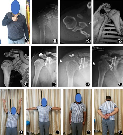 Treatment of Chronic Anterior Shoulder Dislocation by Coracoid ...